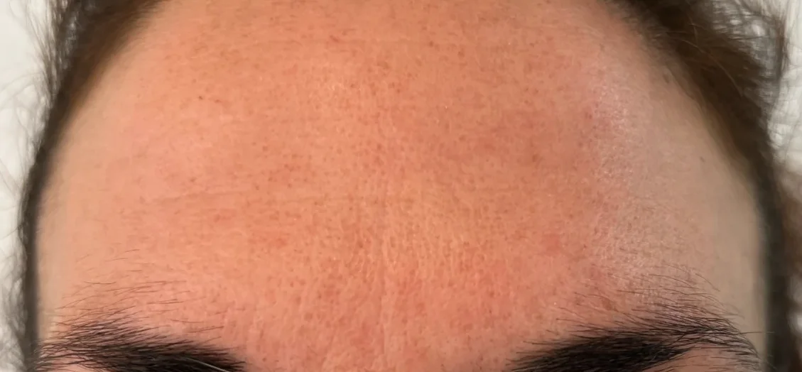 Después: tratamiento antiarrugas – caso 1