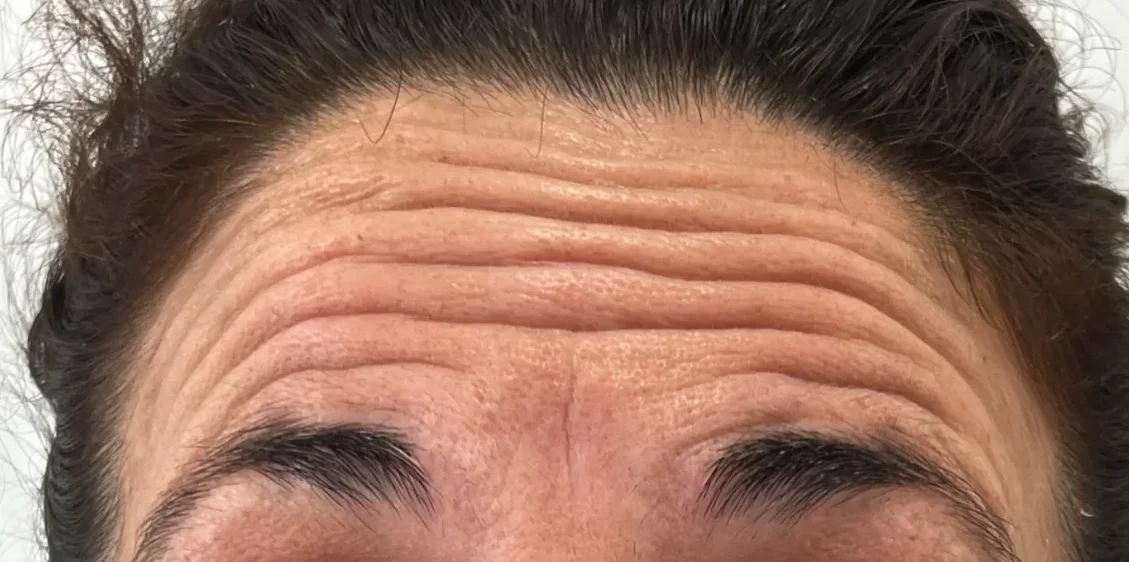 Antes: tratamiento antiarrugas – caso 1