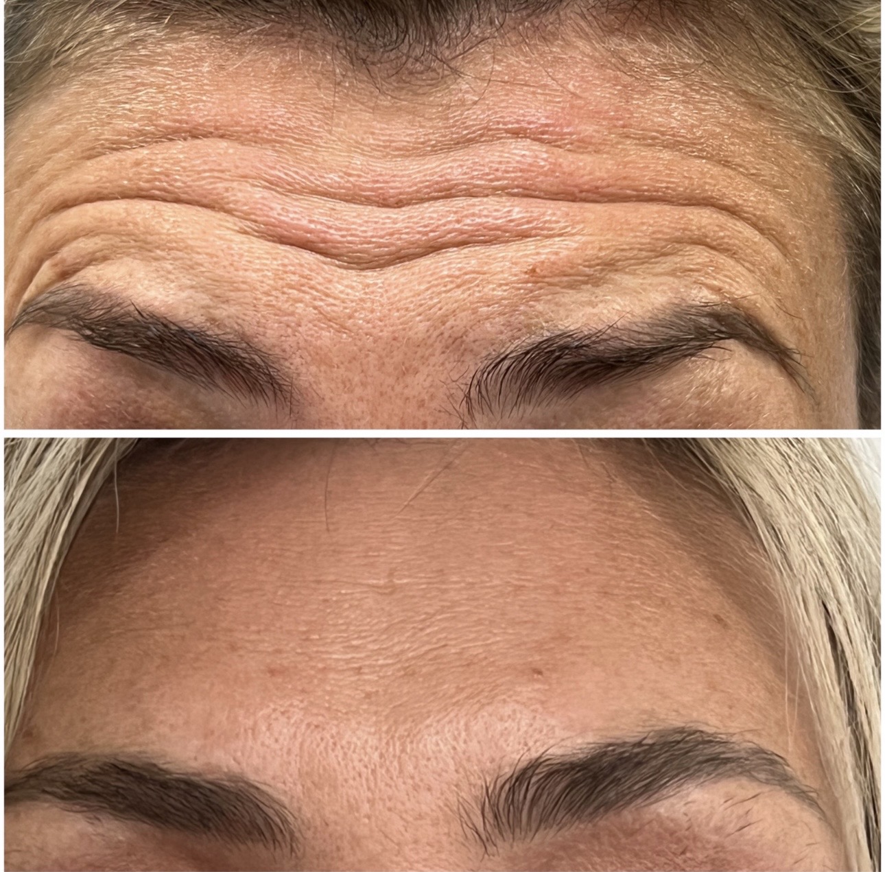 Antes y después de tratamiento de arrugas de expresión en el entrecejo en Irina Clinic