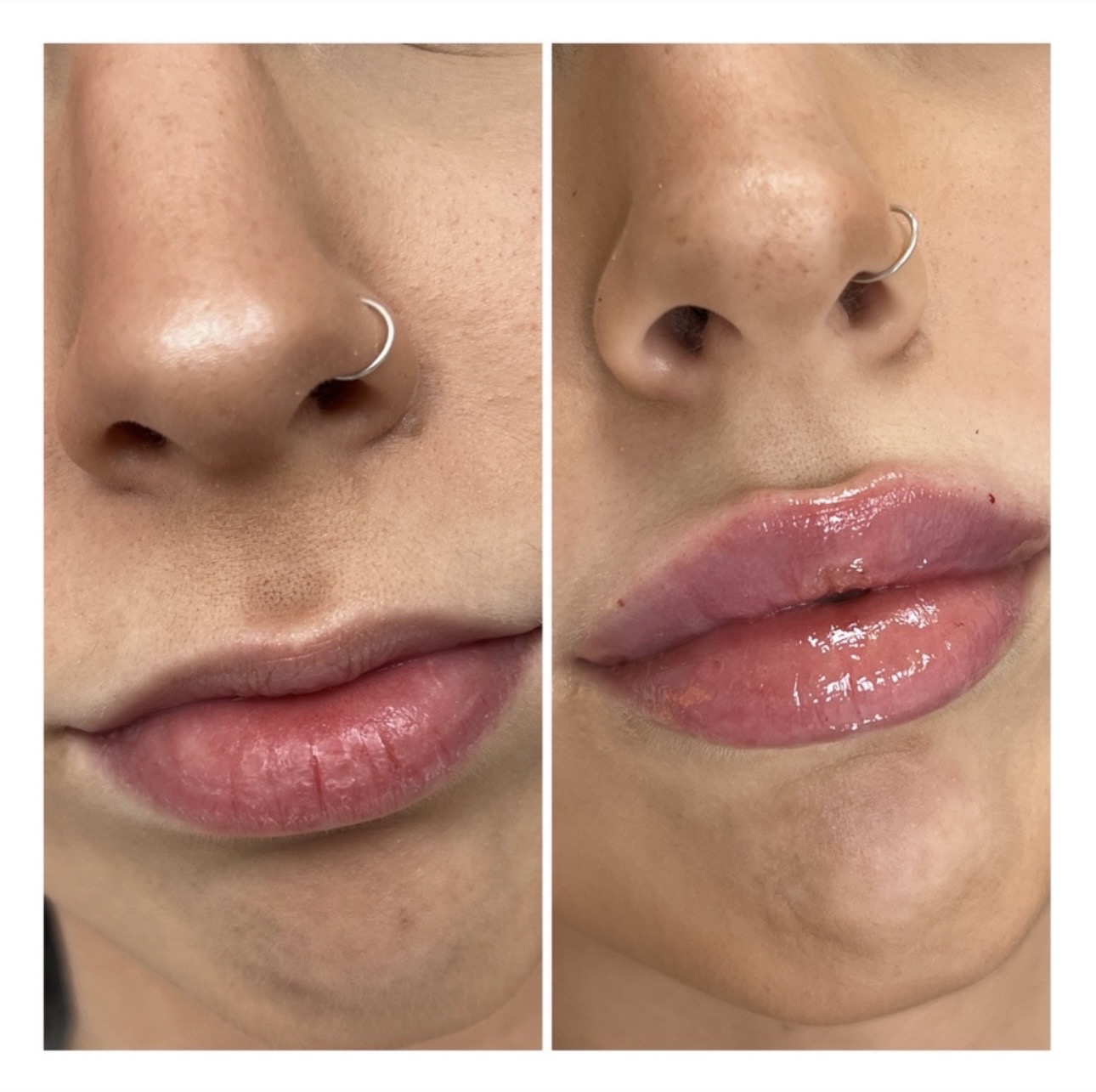 Antes y después de aumento de labios con ácido hialurónico en Irina Clinic