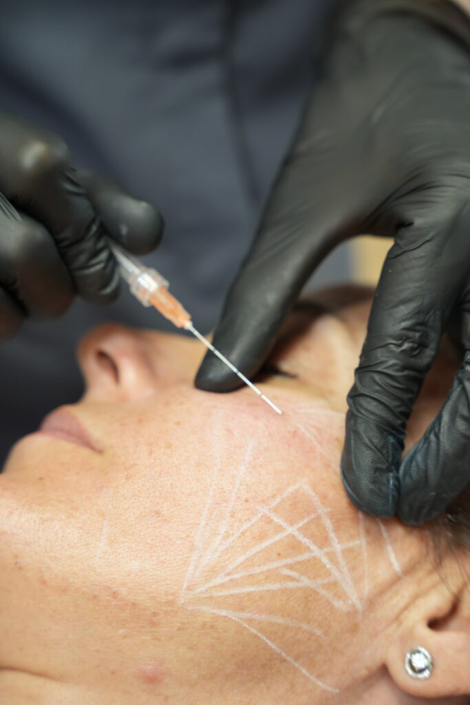 Mujer adulta en valoración del contorno facial para un tratamiento con hilos tensores