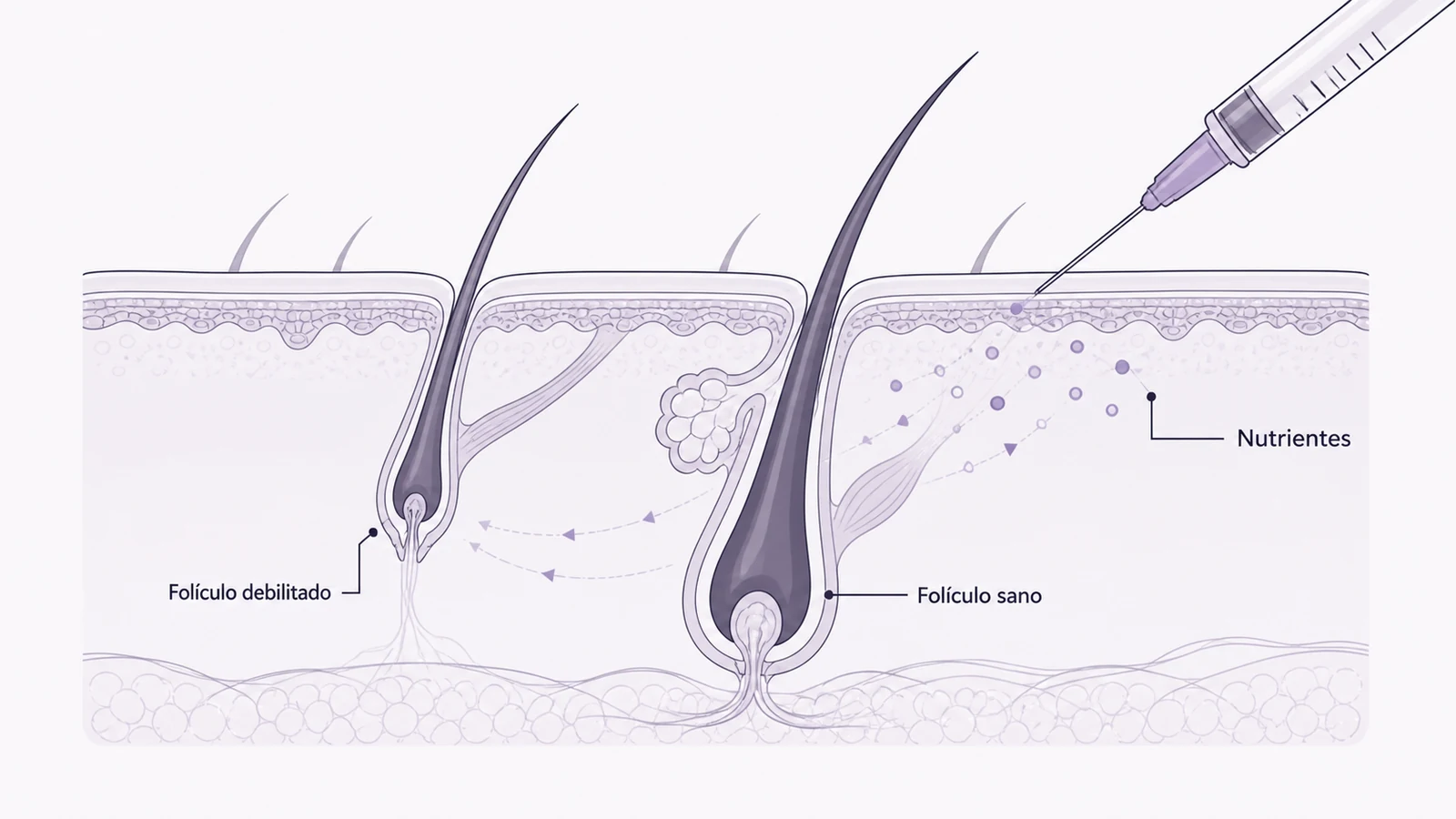 Ilustración médica sobre corte del cuero cabelludo y el folículo piloso en tratamiento de la caída del pelo