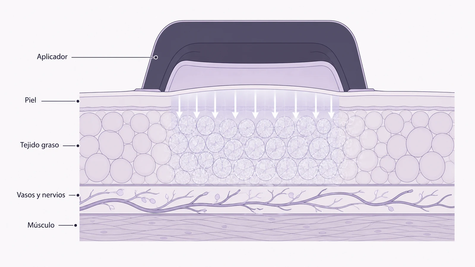 Ilustración médica sobre corte del tejido durante la criolipólisis en criolipólisis