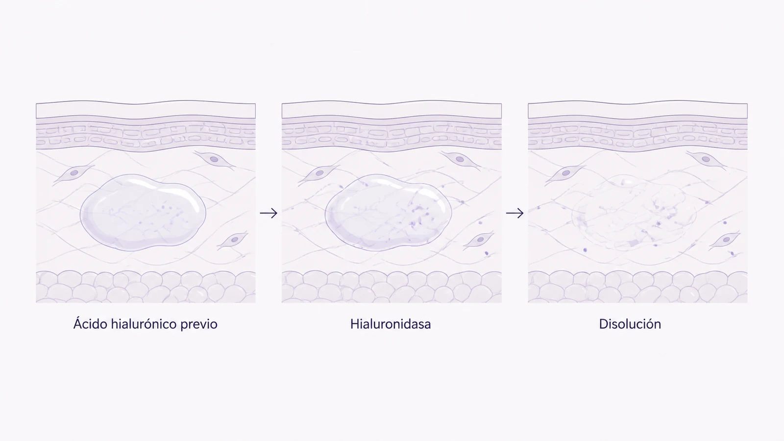 Ilustración médica sobre disolución del ácido hialurónico en hialuronidasa