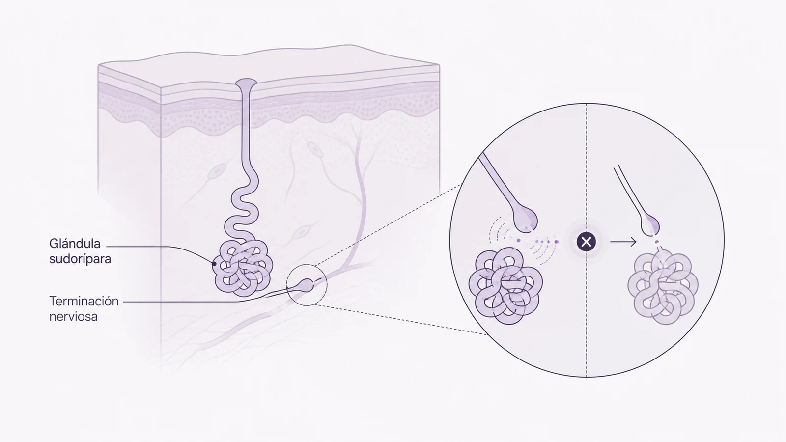 Ilustración médica sobre bloqueo de la glándula sudorípara en tratamiento de la hiperhidrosis