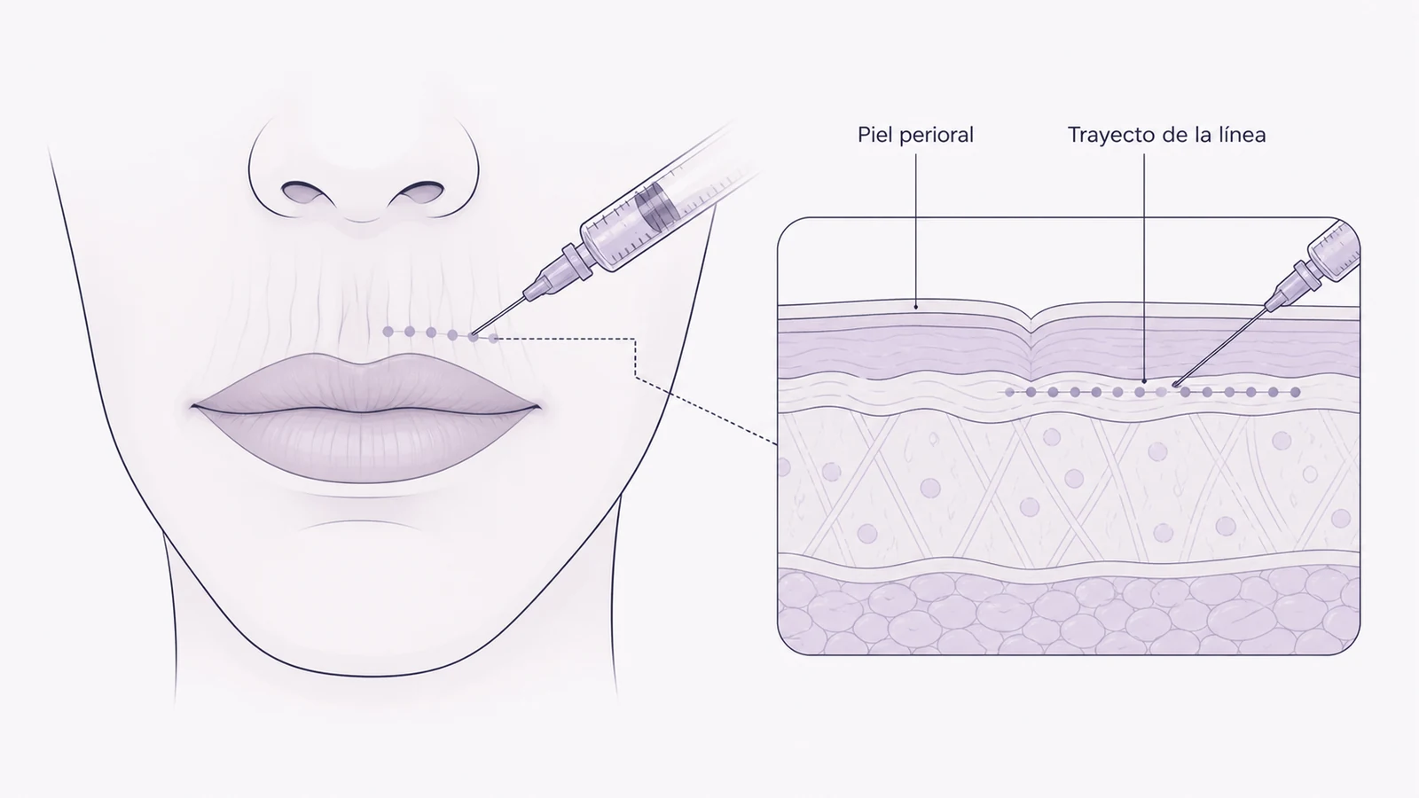 Ilustración médica sobre infiltración superficial en el trayecto de la línea en tratamiento de las líneas periorales