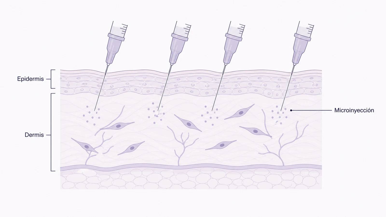 Ilustración médica sobre microinyecciones intradérmicas en mesoterapia facial