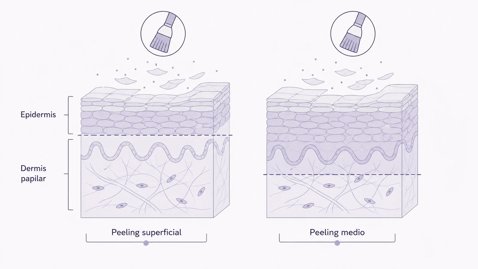 Ilustración médica sobre profundidad de acción del peeling en peeling médico