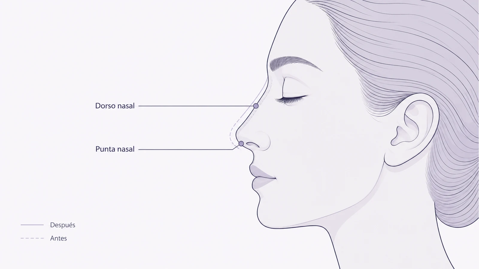 Ilustración médica sobre puntos de infiltración del perfil nasal en rinomodelación sin cirugía