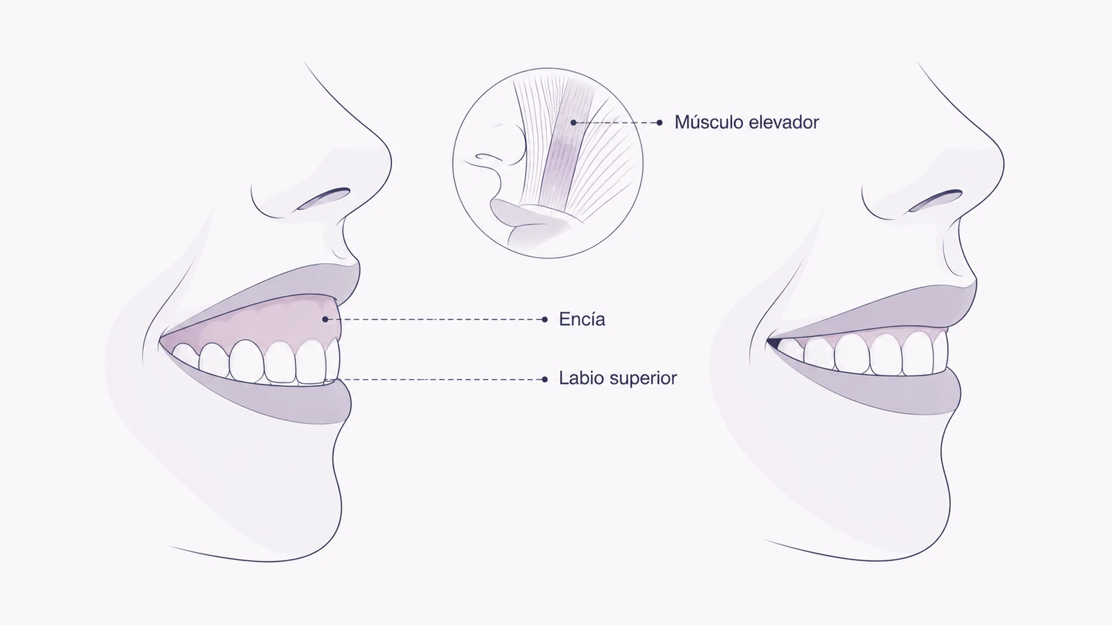 Ilustración médica sobre elevación del labio superior antes y después en tratamiento de la sonrisa gingival